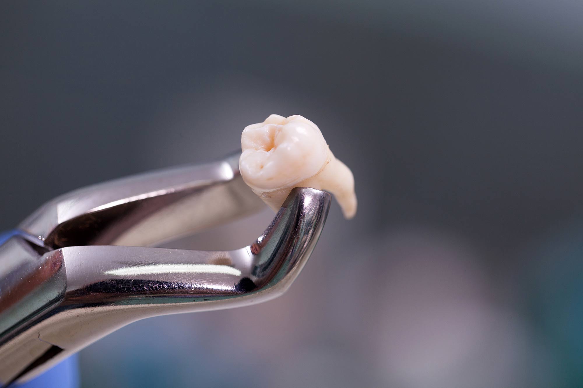 A tooth being held by an extraction tool.