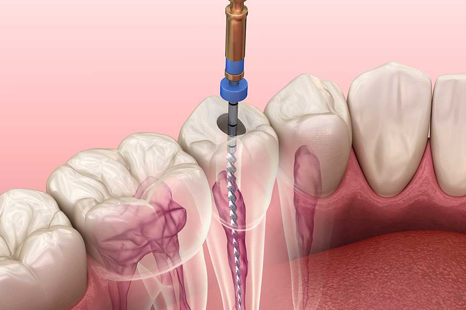 An endodontics procedure being performed on teeth.